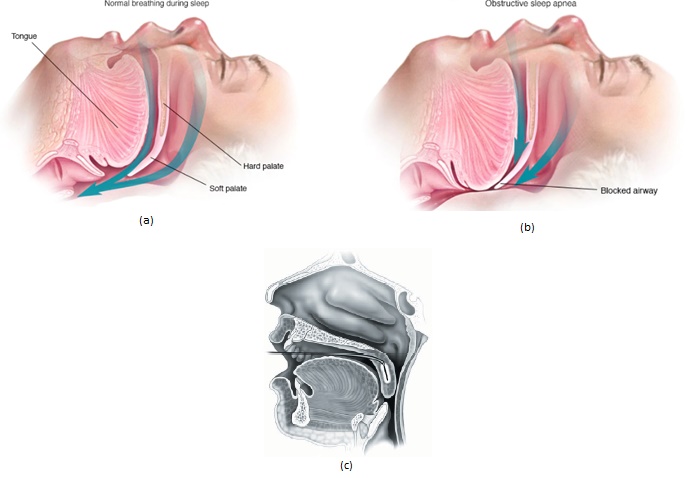 Illustration of the breathing operation (a-without and (b-with the OSA.[1] (c- Insertion of microwave antenna into soft palate region 