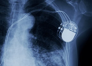 Traditional implanted pacemaker 